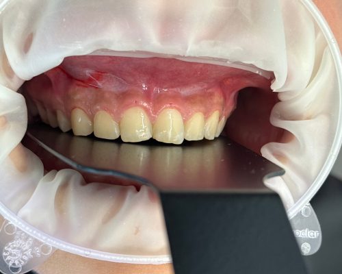 Ceramics and gum aesthetics, before