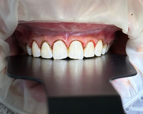 Ceramics and gum aesthetics, after