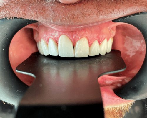 Gum contouring, after