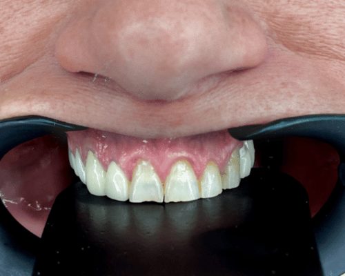 Composite smile design, before