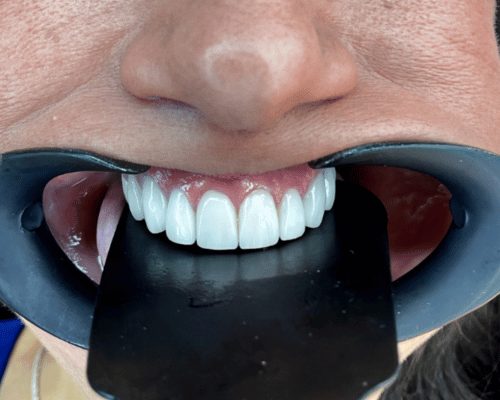 Composite smile design, after