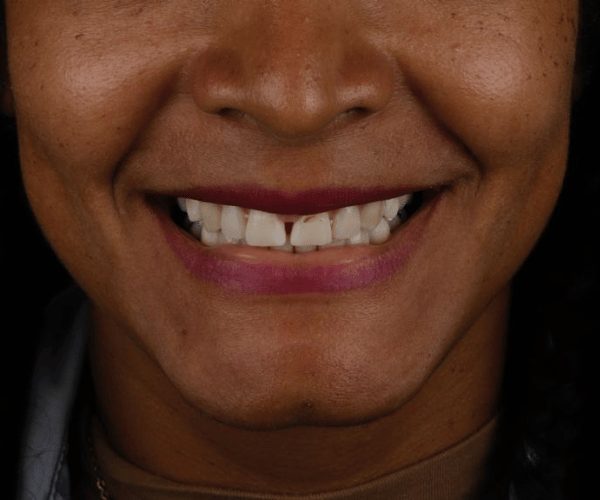 Smile design, before