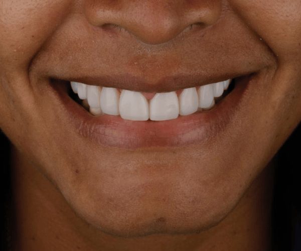 Smile design, after