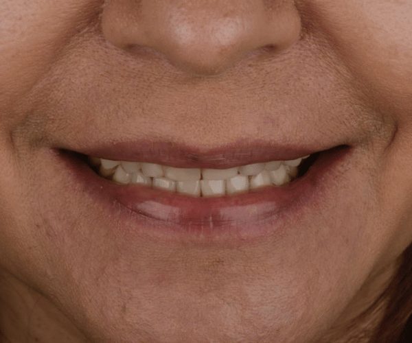 Smile design, before