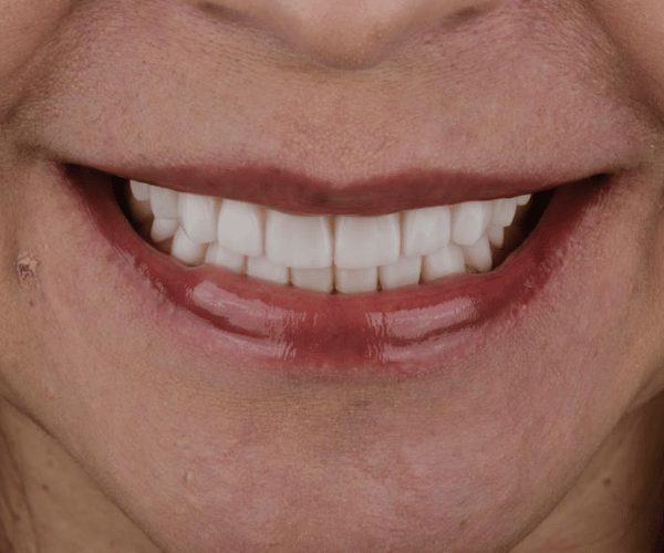 Smile design, after