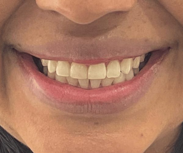 Smile design, before