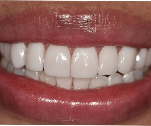 Smile design, after