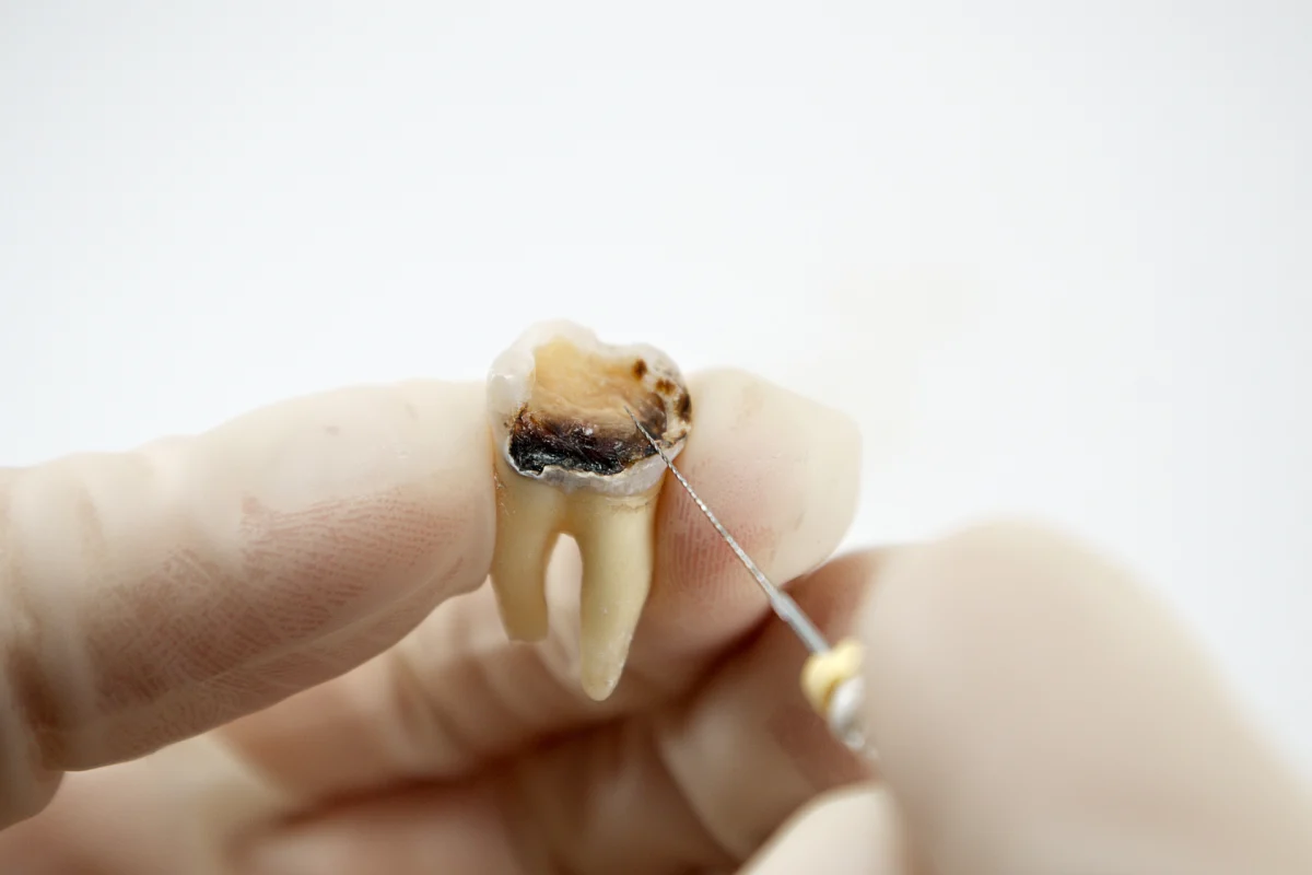 endodoncia